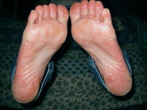 One Day Without Shoes 2012 Feet 3